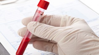 Kann man Krebs per Bluttest erkennen?